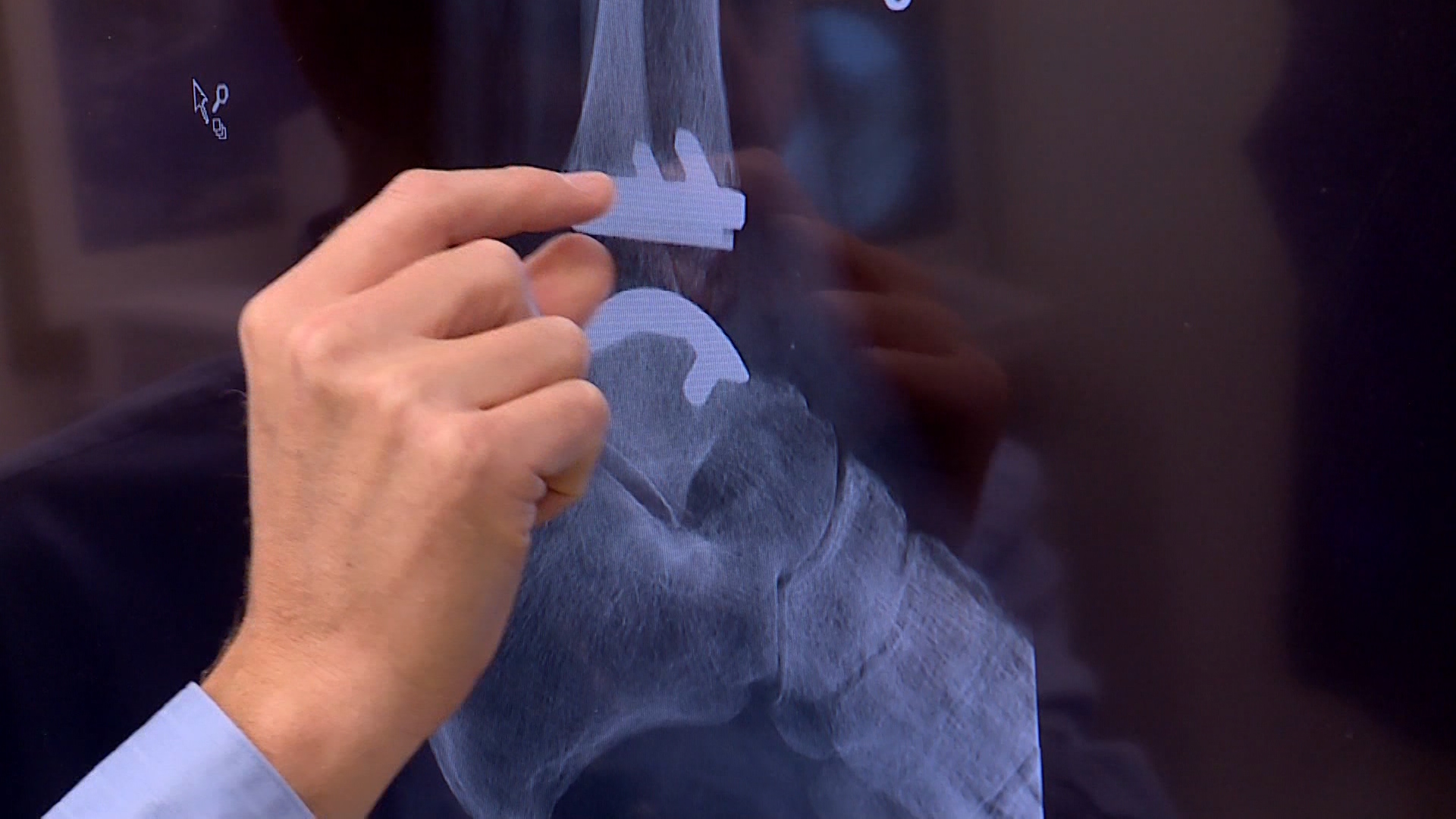 New artificial joint technology helping to relieve arthritic ankle pain