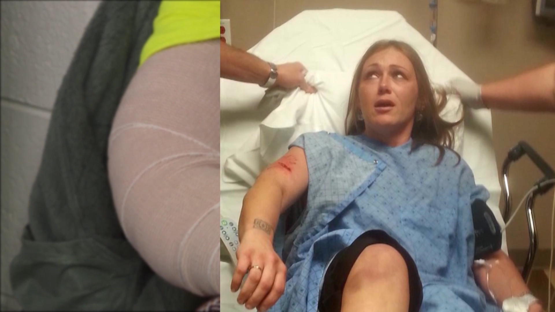 Roy woman recounts dog attack that left her arm mangled