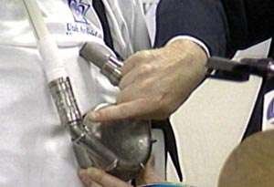 LDS Hospital Implants Milestone 150th Aritificial Heart