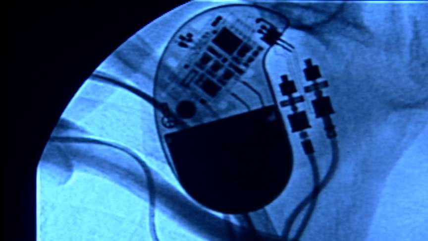 Patients Frustrated Over Pacemaker Recall
