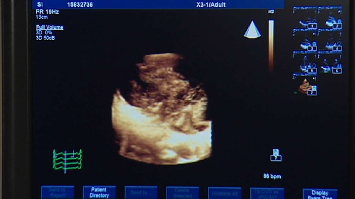 3D Technology Shows Non-Invasive View of Heart