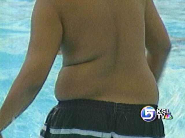 Overweight Children Face Risk of Broken Bones