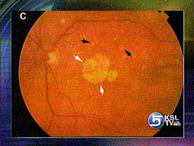 Blood Test Could Detect Macular Degeneration Years Earlier