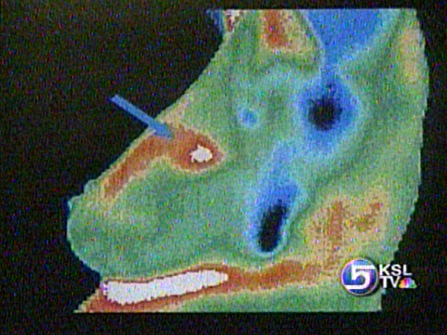 New Evidence Shows Breast Cancer Deadlier in Certain Women