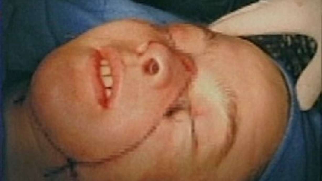 First Face Transplant Successful So Far