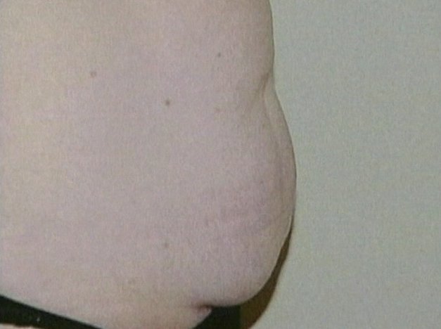 New Version of Liposuction Liquefies Fat