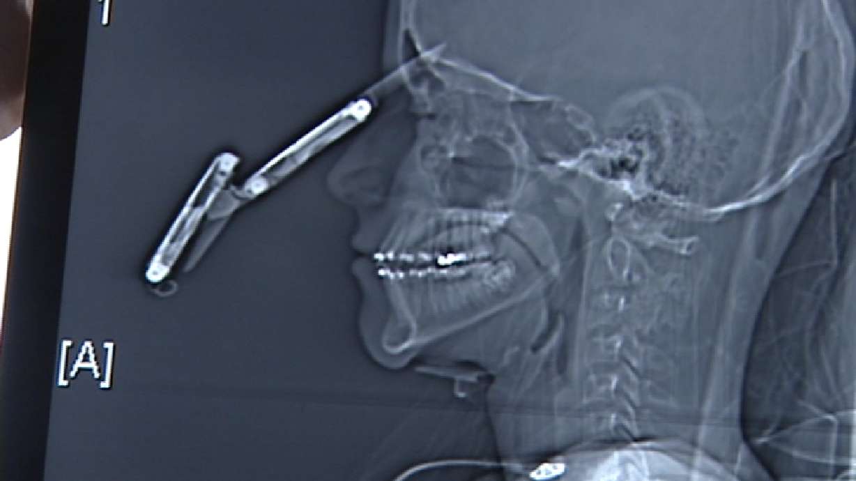 Teen Surprisingly Well After Getting Knife Lodged in Head