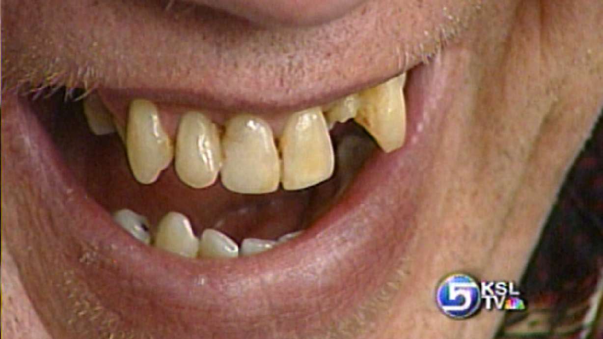 Medicaid Recipients to Lose Dental, Vision Benefits