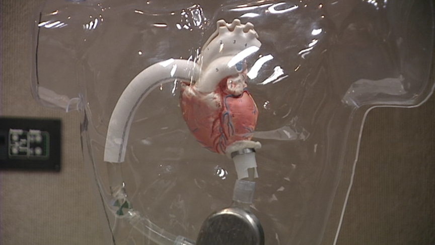 Revolutionary Artificial Heart Implanted for First Time