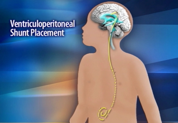 Primary Children's hospital working to alert parents of shunt recall