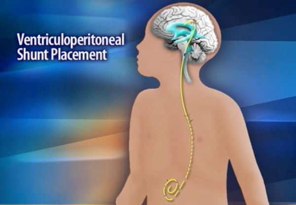 Primary Children's hospital working to alert parents of shunt recall