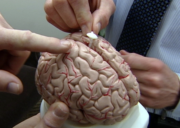 A doctor demonstrates how the shunt is placed in the child's brain