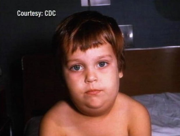 Health Officials Urge Mumps Vaccines 