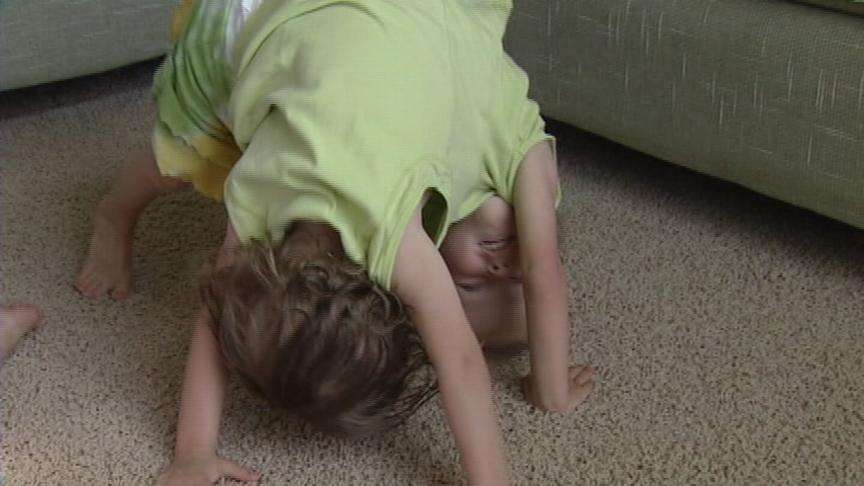 Doctors Preparing Conjoined Twins for Eventual Separation