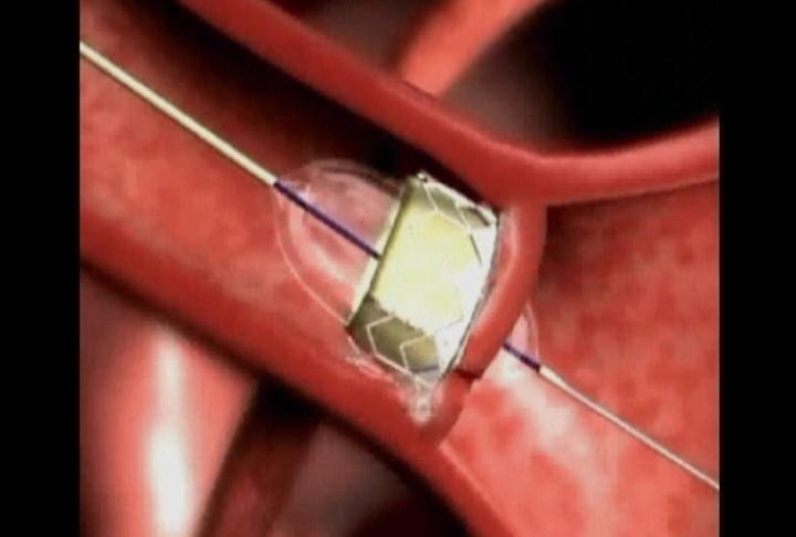 Heart valve surgery without opening the chest