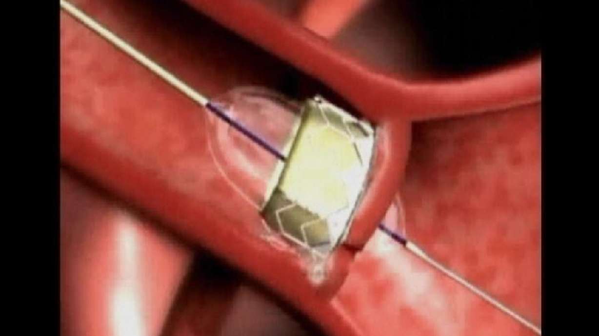 Heart valve surgery without opening the chest