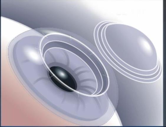 Revolutionary Laser Technique Being Used for Cornea Transplants