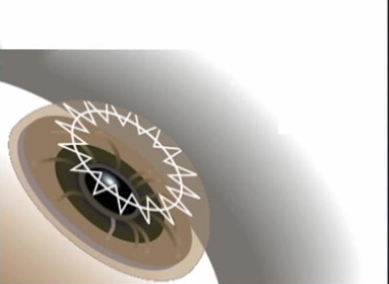 Revolutionary Laser Technique Being Used for Cornea Transplants