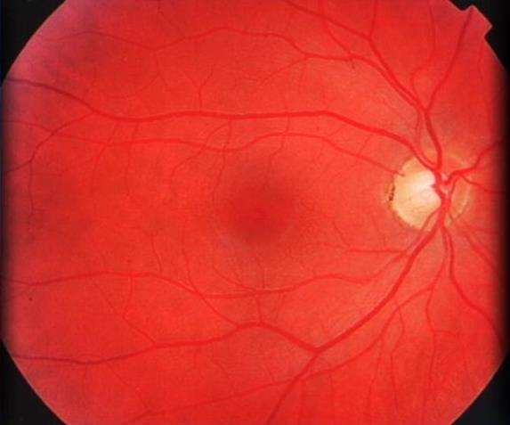 A Closer Look at Retinoblastoma