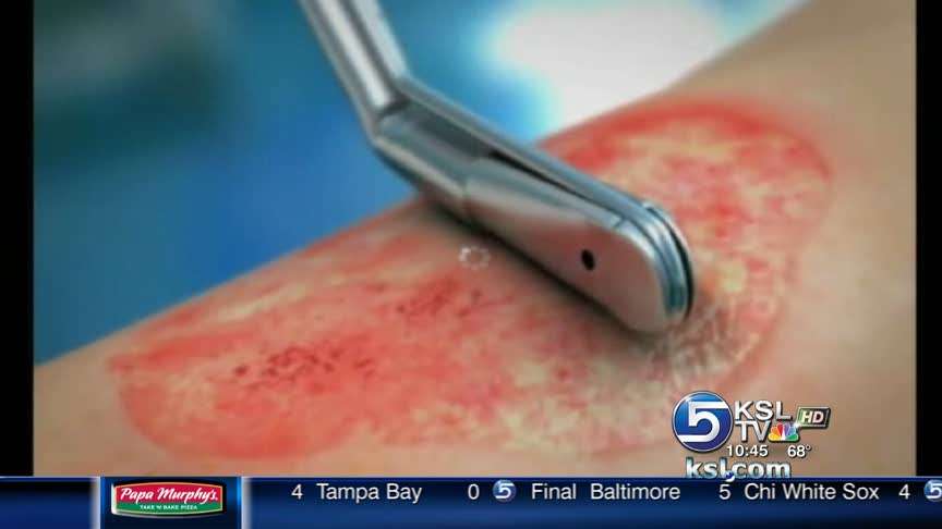 SportsBeat Spotlight: Allergic reaction sent hockey player to burn unit