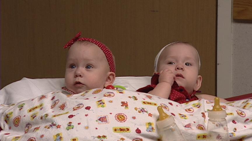 Conjoined Twins to be Separated in Two Weeks