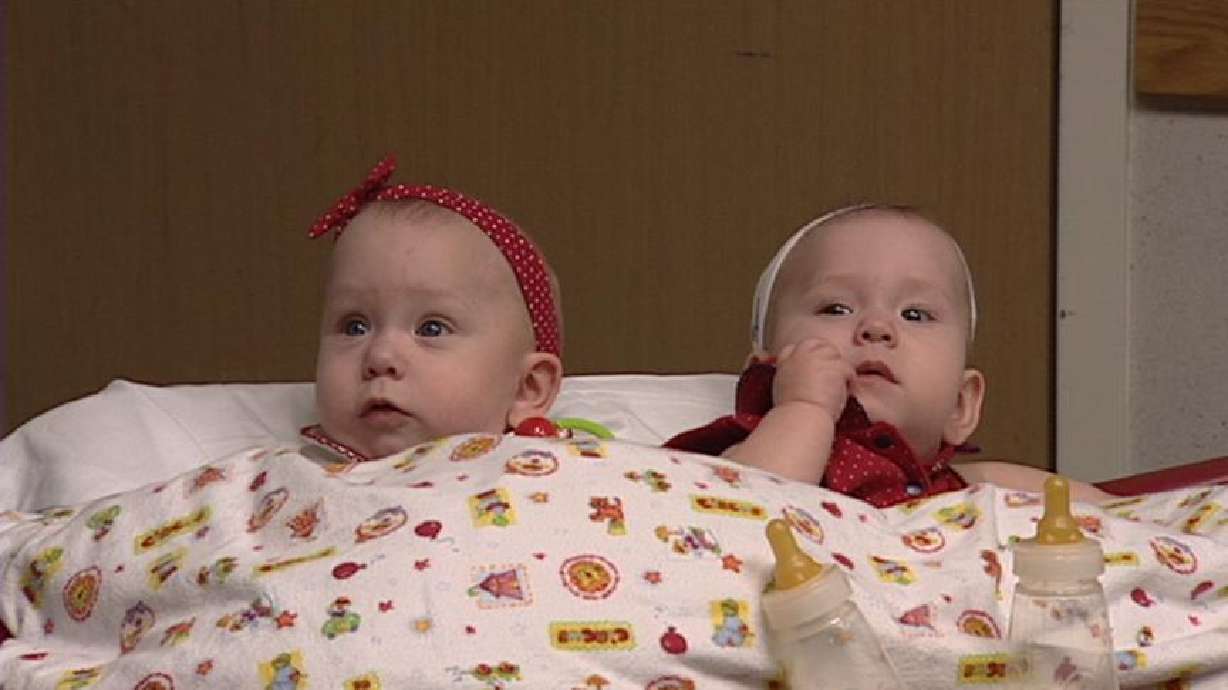 Conjoined Twins to be Separated in Two Weeks
