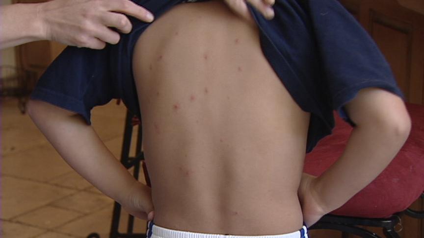 Some Children are Getting Chicken Pox Even Though They are Vaccinated