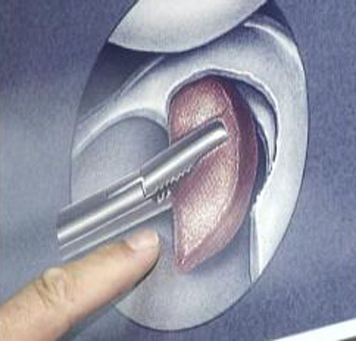 Medical implant helps patients regrow cartilage