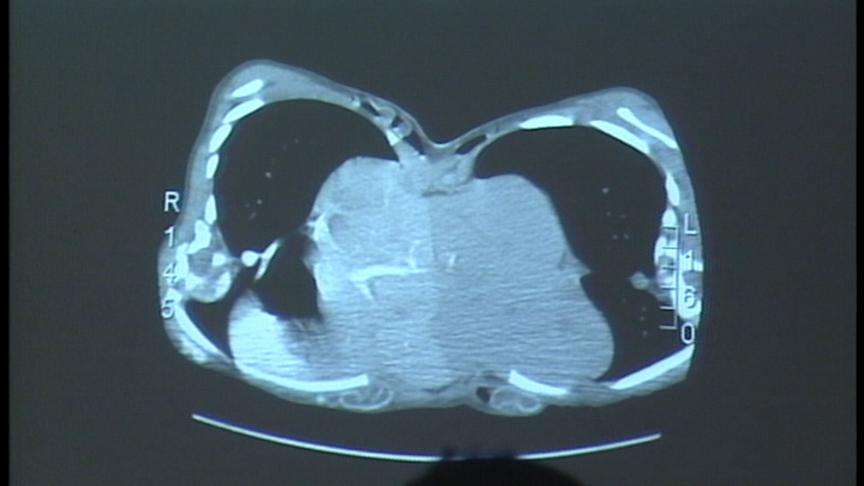 Surgeons Prepare to Separate Conjoined Twins