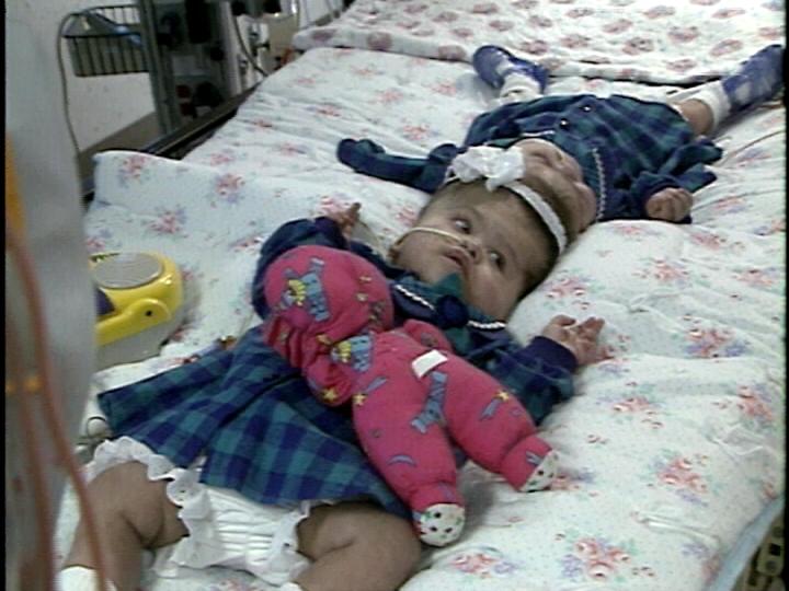 Utah Surgeons Have Separated Conjoined Twins Before