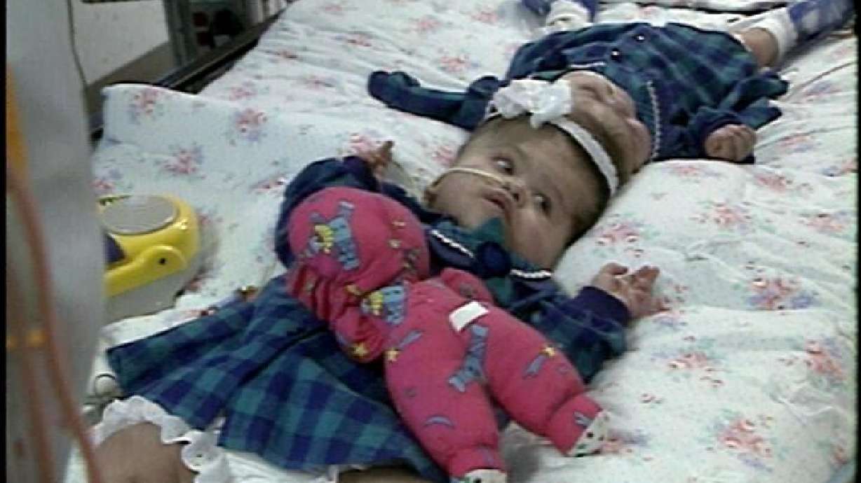 Utah Surgeons Have Separated Conjoined Twins Before