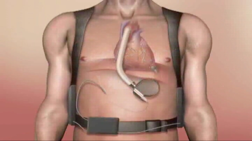 Rendering of fourth-generation Levacor ventricular-assist device.