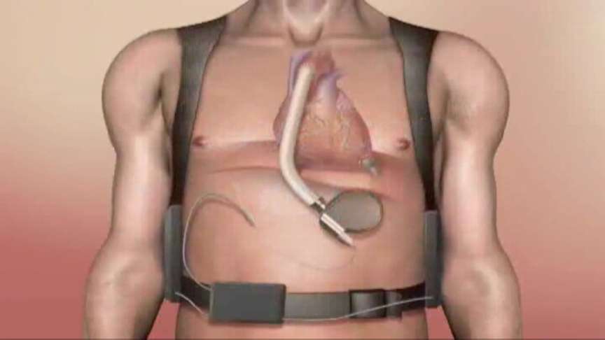 Rendering of fourth-generation Levacor ventricular-assist device.