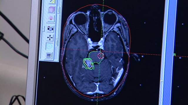 Gamma Knife Destroying Brain Tumors without Surgery