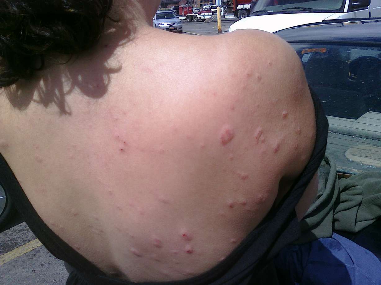 Rebecca Bates took the brunt of the blow from broken glass and rocks on her back when she and her husband drove through a massive storm in Parleys Canyon.