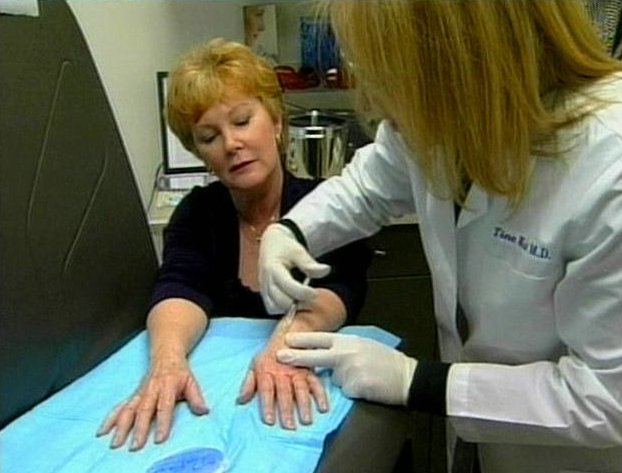 New Procedure Reduces Signs of Aging in Hands