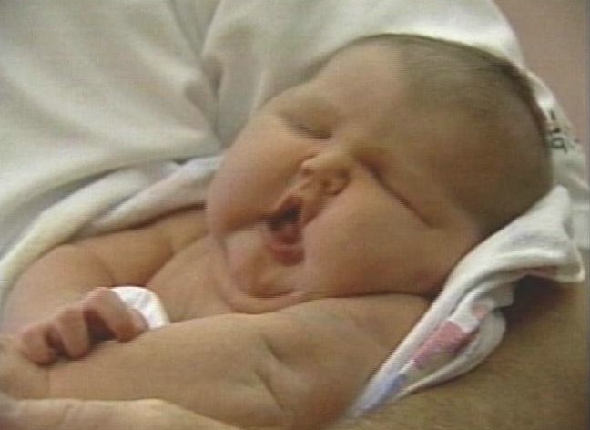 Rapid weight gain in babies could lead to obesity later on