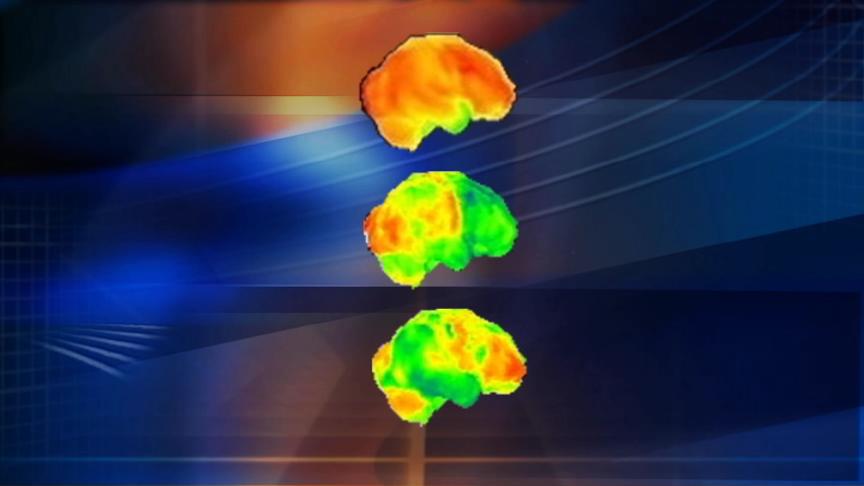 University of Utah Study May Help Alzheimer's Patients