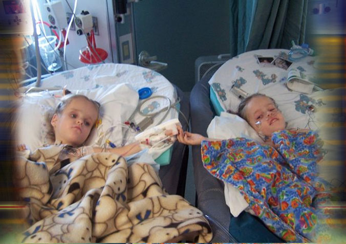 Separated Twins Continue to Heal in ICU 