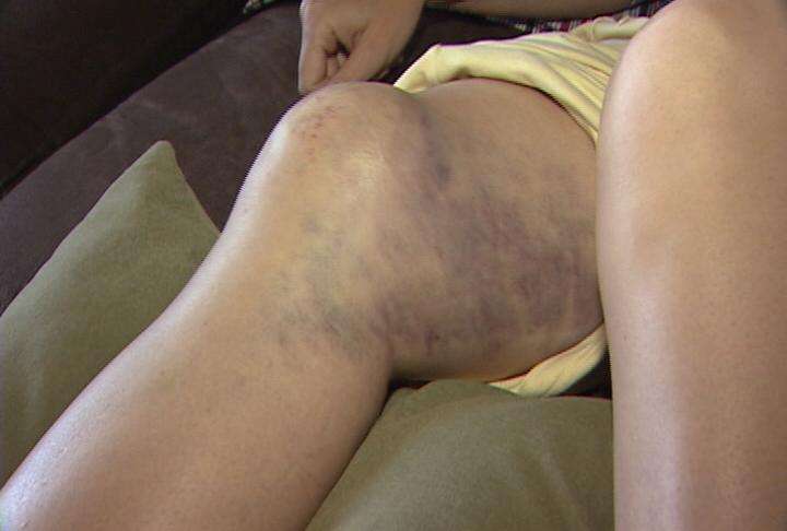 The buffalo rammed Hayes in her left thigh, flipping her over. She landed on her right leg, which is now badly bruised.