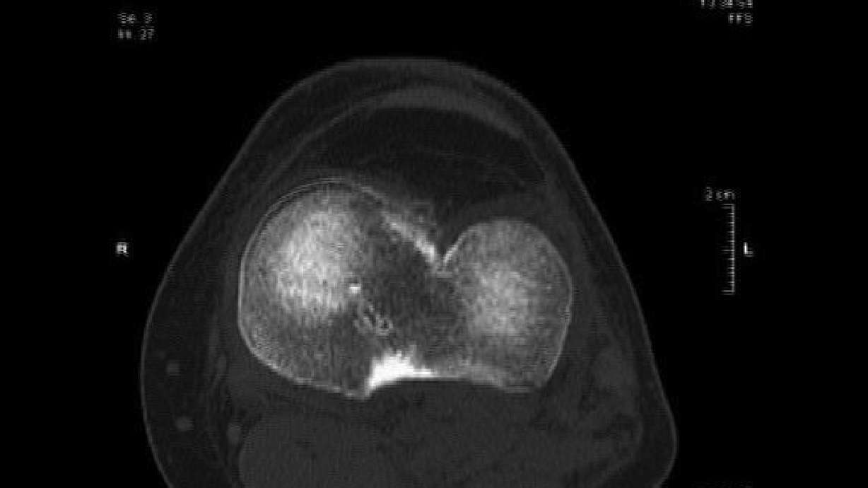 Later Knee Treatment?