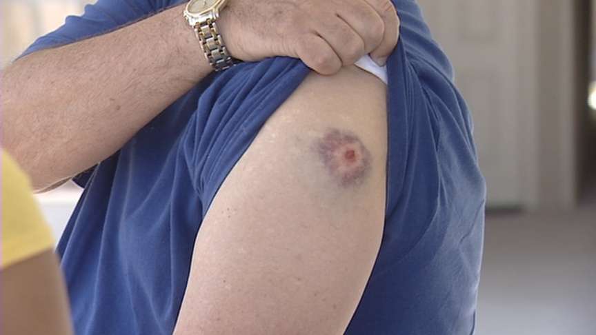 Richard Burrows was hit in the arm by shrapnel from the fireworks