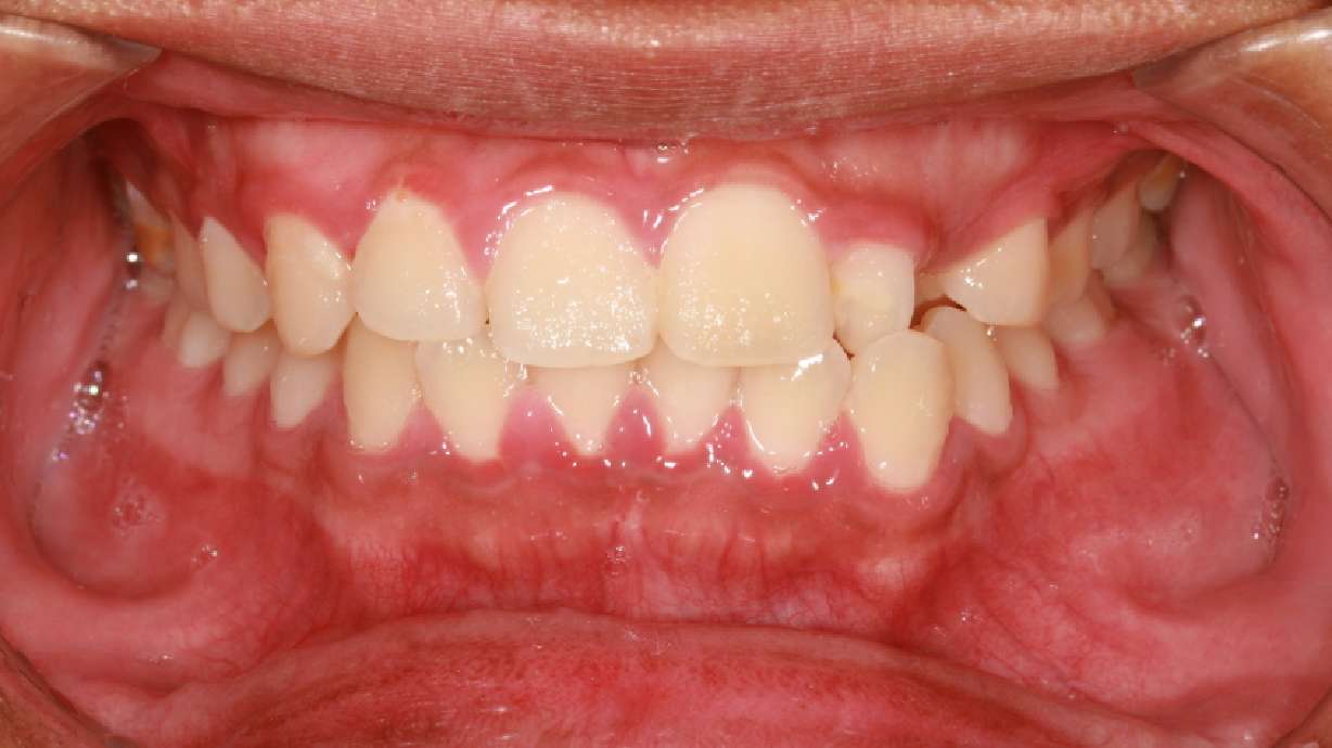 Gum Disease and Your Heart