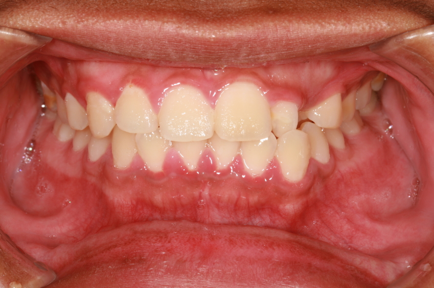Gum Disease and Your Heart 
