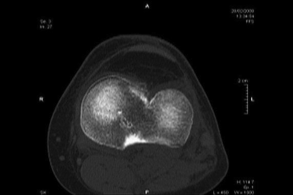 Later Knee Treatment?