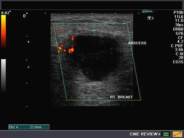 Another Smoking Danger 