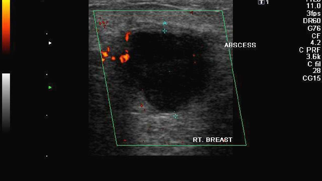 Another Smoking Danger