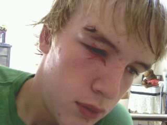 Dyllan Williams had to get 5 stitches above his eye after the attack (Courtesy: Dyllan Williams)