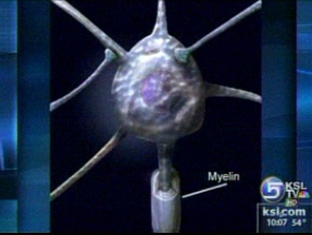 Mayo Clinic Research Offering Hope to MS Patients