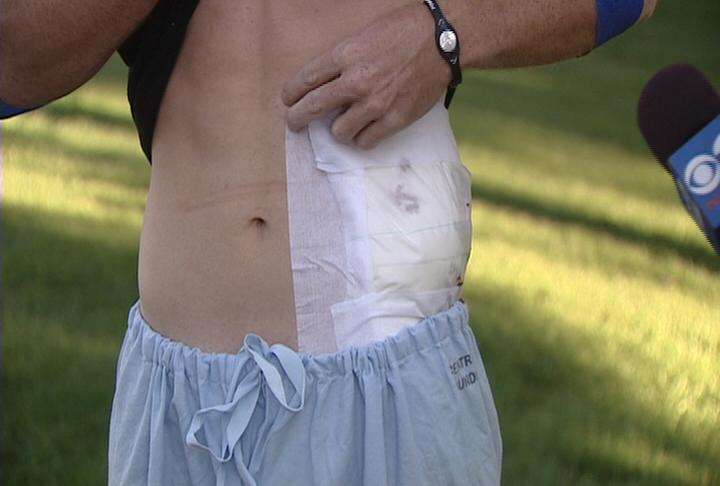 Tim Carroll shows the wound he received from being shot by a man he believes was burglarizing his home.